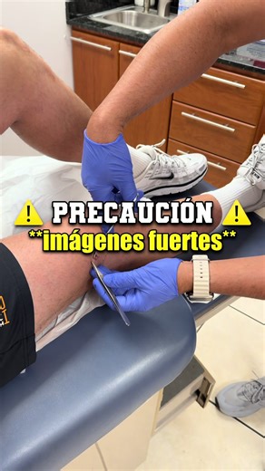 Me operaron la Rodilla el Ligamento Cruzado Anterior (ACL) - Week 1 Update ⚠️👀 #dribblebros #baloncesto