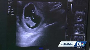 Alabama's robotic ultrasound plan raises concerns from OB-GYNs