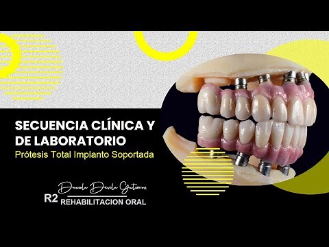 Prótesis Híbrida en pacientes edéntulos totales / Secuencia clínica y de laboratorio