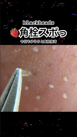 鼻の角栓をピンセットで抜くだけの動画。blackheads・去黑头・comedones・각마개#いちご鼻 #毛穴 #毛穴パック