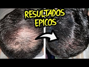 MINOXIDIL y FINASTERIDE 6 MESES RESULTADOS en el CABELLO | FINASTERIDE para Caida de Pelo