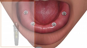 1.4K views · 41 reactions | Prosthetics technique: multi-unit abutment open tray technique using the direct pick-up coping. | BioHorizons | Facebook