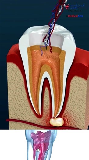 Root Canal Treatment #shorts