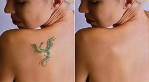 Laser Tattoo Removal SA – Medium Tattoos | Fast & Effective