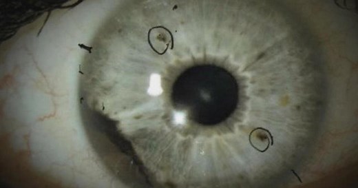 Rare eye cancer affects 2 groups of people in N.C. and Alabama