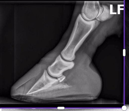 P3 rotation is killing horses. And it’s all totally preventable and completely caused by imbalanced hoof care. Check out Hector’s left fore before and after rebalancing. He’d only just arrived at Gawsworth Track Livery and this was done the same day. Shoes off, the hoof capsule realigned and P3 de-rotated. Hector was going to be pts for P3 rotation just about to penetrate. Just another ‘number’ they didn’t know how to fix. All because the hoof care pro had allowed the heels to rise, the sole to 