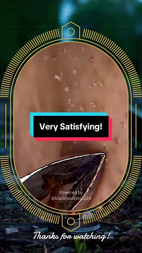 SqueezeUK popping acne pimple Satisfying abcess blackhead Removal viral #blackheads #pimplepop #skincare #acne #pimple @BlackheadsTV