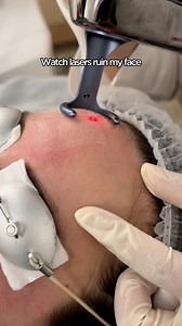 Want flawless skin? CO2 Fractional Laser is a must-try! ✨ Check out the results from Lydie Vu’s favorite treatment – smoother texture, refined pores, and an even skin tone. More than just a surface treatment, CO2 laser works deep within to boost collagen, keeping your skin firm, radiant, and youthful over time. 👉🏻 Ready to experience the hottest laser technology? Book your appointment now! #glo365 #beauty #fractionallaser #laser #treatment | Glo365 Medical Group