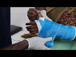 Below elbow cast application for Distal radius Fracture