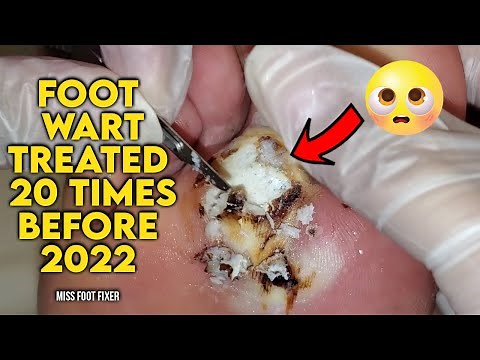 BIGGEST FOOT WART EVER??? [TREATED 20 TIMES BEFORE ] BY MISS FOOT FIXER