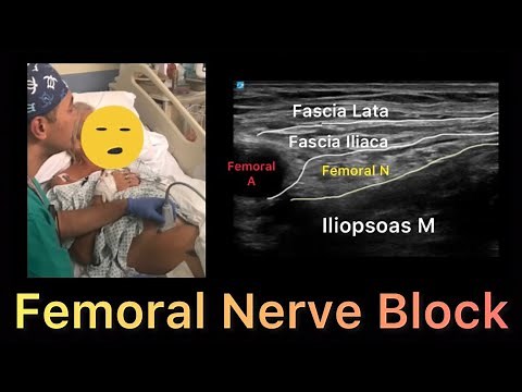 Femoral Nerve Block ( Ultrasound Guided)