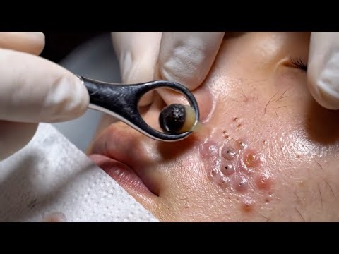 Gentle Tweezer ASMR ✨ Satisfying Deep Pore Extraction for Flawless Skin