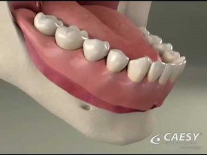 Dentures Adjust & Reline - Roseville Dentist