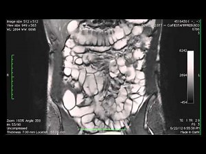 Cine MR imaging of the small intestine in a case of bowel MRI