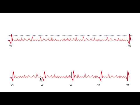 Pacemaker Issues Explained (Part 3): Navigating Oversensing