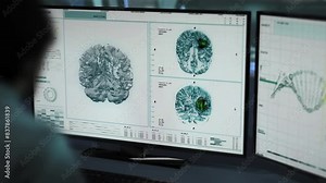 Innovative Oncology Scanner Analyzing Brain Tumor. Modern Oncology Scanner Working Process On A Medical Computer Program. Advanced Oncology Scanner Used In A Neurological Diagnosis.