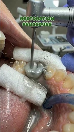 RESTORATION PROCEDURE 🦷😬