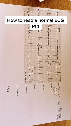 Understanding a Normal ECG: Step by Step Guide