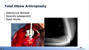 Elbow Fractures: Role of Arthroplasty