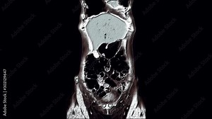 Contrast MRI of the abdominal cavity, gastrointestinal tract, bladder