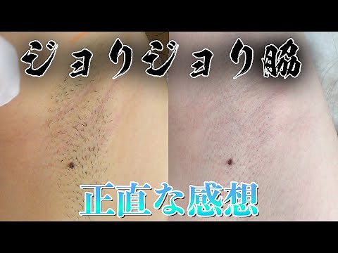 【医療脱毛】6回のワキ脱毛と5回の膝下脱毛に密着＆インタビュー！