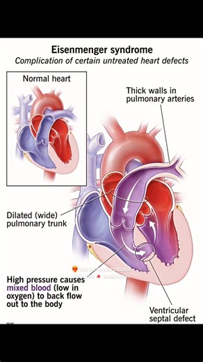drchetancreation.in on Instagram: "The Eisenmenger Syndrome triad describes the progression of a congenital heart defect (like a VSD or ASD) where a long-standing left-to-right shunt causes severe, irreversible pulmonary hypertension, leading to reversed blood flow (right-to-left shunt) and resulting in cyanosis (bluish skin), significant hypoxemia, and clubbing of the fingers, making it a multisystem disorder with serious risks like bleeding, heart failure, and stroke. Here's a breakdown of the