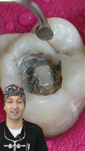 How To Remove The Faulty Silver Filling From Tooth #shorts