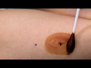 IMPLANON NXT insertion video for Doctors.