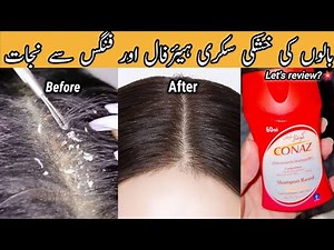 Conaz Lotion Shampoo Based Dandruff free scalp ! #haircare #unfreezmyaccout #scalpcare