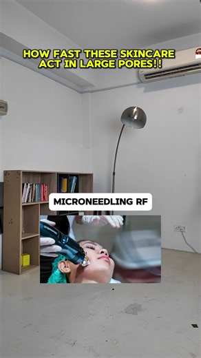 Want smaller-looking pores? Here's how fast treatments usually work: Microneedling RF → Fastest results Chemical Peels → Moderate results over multiple sessions Retinol Serum → 8 to 12 weeks with consistent use Niacinamide Clay Mask → Gradual improvement and maintenance Pore size won't change overnight. Consistency gives the best results. Save this pore treatment guide. Follow for skincare tips inside out.