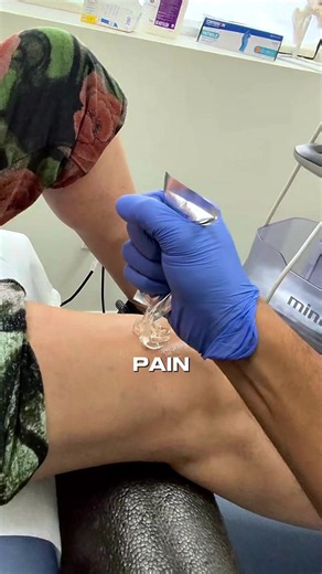 Why would a doctor remove fluid from your knee before giving you a gel injection? 💉 When someone has knee osteoarthritis, inflammation can sometimes cause excess fluid to accumulate inside the joint. This buildup can lead to swelling, pressure, stiffness, and difficulty bending or straightening the knee. In certain cases, treatment may involve two steps during the same visit. Step 1: Knee aspiration The physician carefully inserts a needle into the knee joint and removes the excess fluid. This 