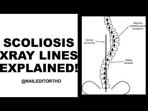 SCOLIOSIS XRAY LINES EXPLAINED CLEARLY