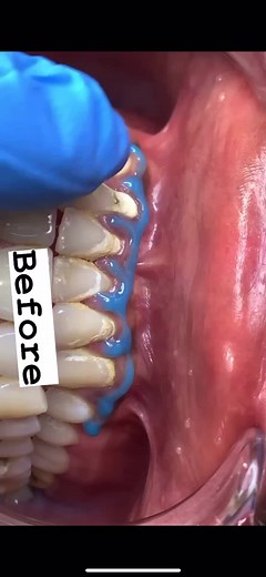 Teeth Scaling #teeth #teethwhitening #teethscaling #fypシ #business