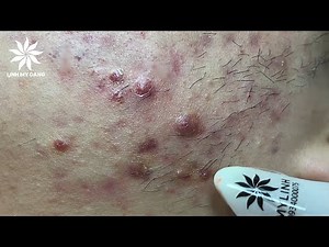 Relaxing Acne Treatment #7 | Inflamed Acnes