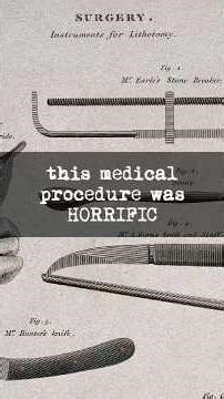 Performed with NO Anesthesia