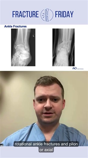 AO SPINE NA on Instagram: "Dr. Colin Cantrell provides a concise overview of the Lauge-Hansen classification system. Learn to master this critical tool for understanding ankle fractures in this Fracture Friday video! ✅ Watch the video to sharpen your skills for your rotations! ✅ Don’t miss AO NA LINK Session 5: The Residency Interview Sessions Happening on November 13th—register now and mark your calendars! 📅 @MSOS #Orthopedics #MedicalStudents #AONA @ckcantrell"