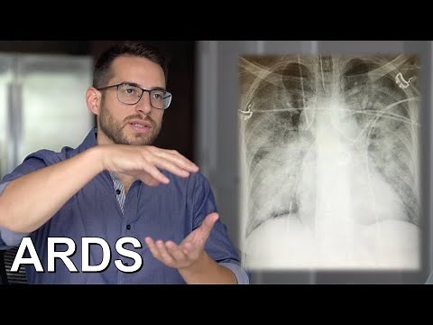 Acute Respiratory Distress Syndrome (ARDS)