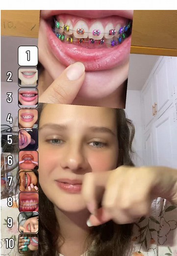 Cambio de ligas de brackets en colores pasteles