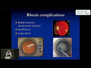 Complications of Cataract Surgery