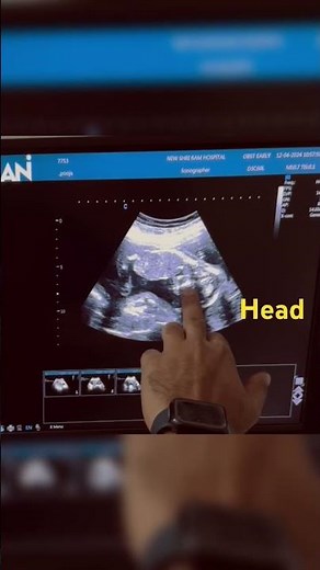 2nd Trimester Ultrasound | fetal anomaly scan |18 Week Baby #pregnancy #ultrasound #ytshorts#anomaly