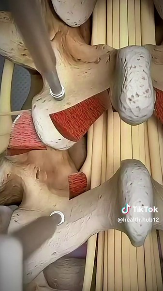 Understanding Herniated Disc Removal Surgery Animation