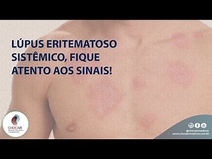 Lúpus Eritematoso Sistêmico, fique atento aos sinais! | Chocair Médicos Associados