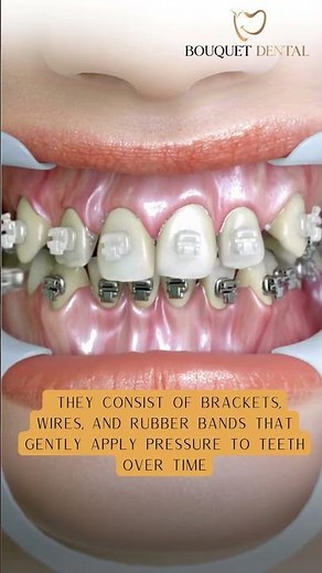 How To Prepare & What To Expect With BRACES | How Braces actually Work | 3D Animation