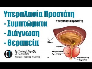 Υπερπλασία Προστάτη Συμπτώματα, Διάγνωση, Θεραπεία
