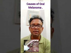 Causes of Oral Melanoma . #Dr.P Roy #dentalsurgeon