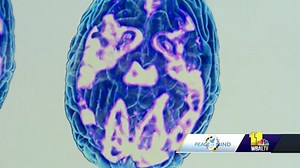 TMS treatment can help treat depression by waking up brain cells