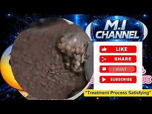jiggers Medical Foot Care education #44 | Relaxing Treatment Video