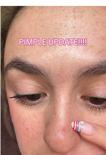 Pimple Update: Scab Removal and Mighty Patches Trial