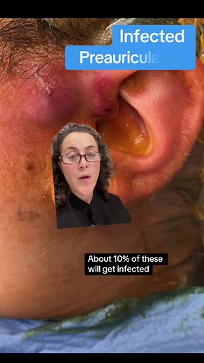 #greenscreen 😳👂: Infected Preauricular Pits need surgical excision. Because they are embryological remnants, it is important that the pit AND it's tract and associated tissues and cartilage is removed of the infection will recur. 👏 Good news: Most pits will never get infected (90%). But please resist the temptation to squeeze them like a pimple or they might. ⚠️ Bilateral ear pits can also be a sign of other incomplete embryological fusions that may be a part of a syndrome. For example, bilat