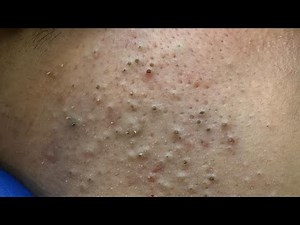 Satisfying Deep Pore Cleansing and Blackhead Removal | Korean Skincare Routine ASMR